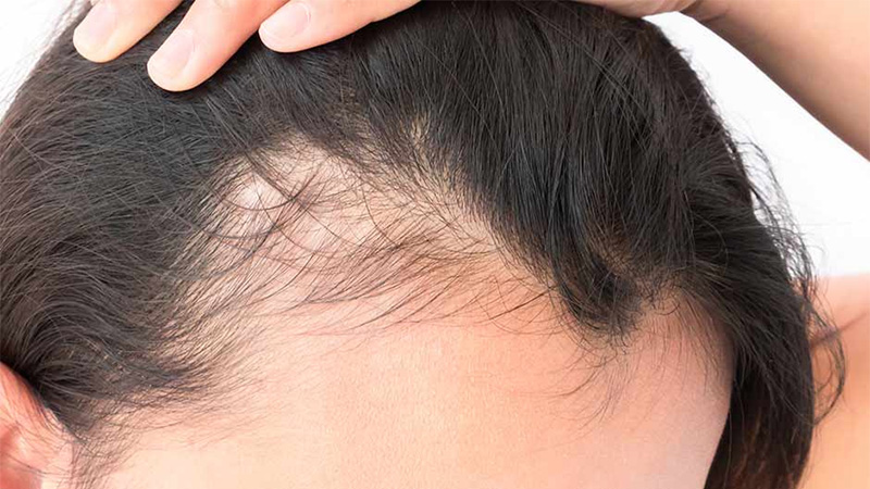 is hair loss from antibiotics reversible